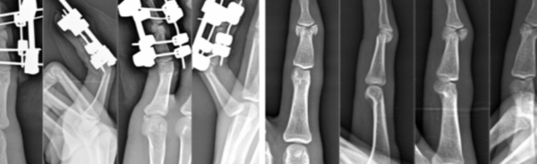 Innovative Techniques for Healing Complex Finger Fractures and Joint Injuries"
