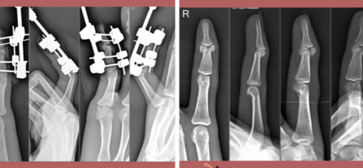 Innovative Techniques for Healing Complex Finger Fractures and Joint Injuries"