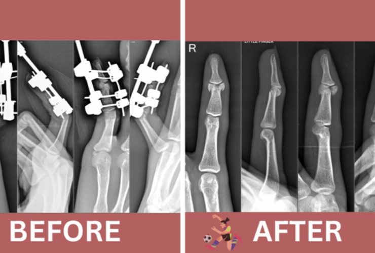 Innovative Techniques for Healing Complex Finger Fractures and Joint Injuries"
