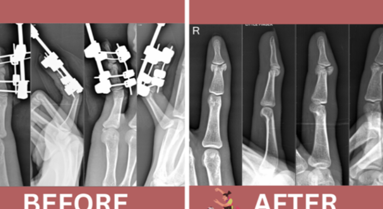Innovative Techniques for Healing Complex Finger Fractures and Joint Injuries"